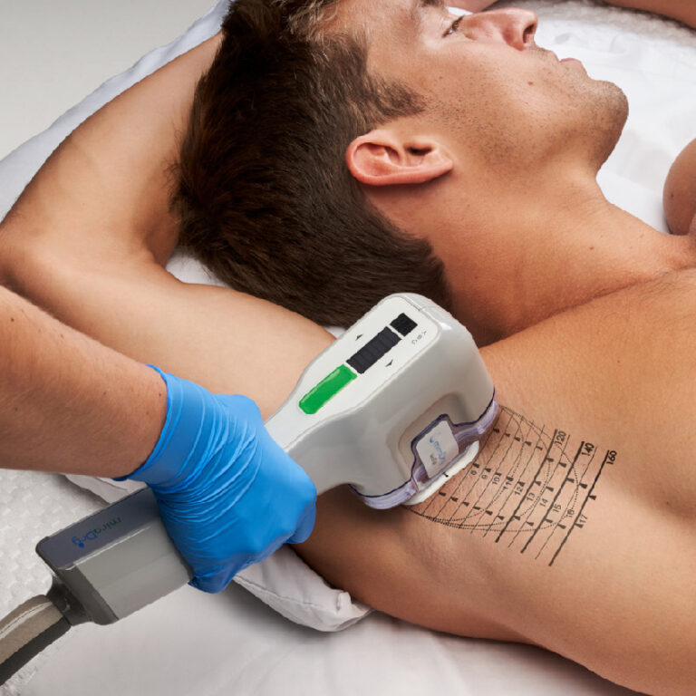 miradry behandlung gegen schwitzen 768x768